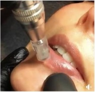 nano-lip