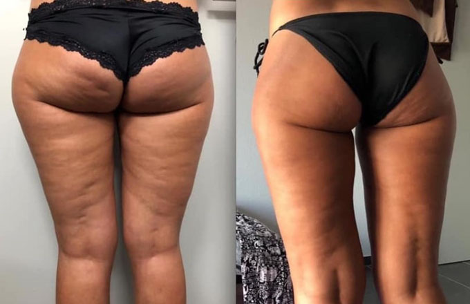 anti-cellulite-voorbeeld-voor-na-1-shaveless pigmentvlek op gezicht verwijderd voor en na