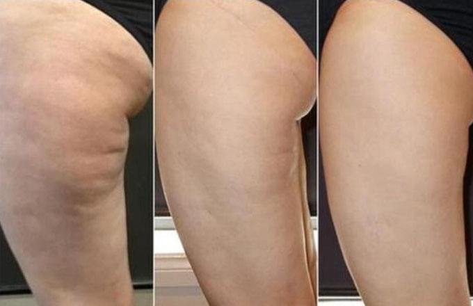 anti-cellulite-voorbeeld-voor-na-2-shaveless pigmentvlekken op hand verwijderen voor en na